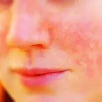 Jika tidak terkontrol dengan baik lupus bisa jadi seganas penyakit kanker, jantung bahkan juga HIV/AIDS. (Foto: hellomd-production.s3.amazonaws.com)