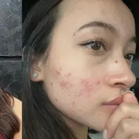 Jerawat jadi salah satu momok menakutkan bagi perempuan, termasuk aktris Megan Domani. [Instagram @megandomani1410]
