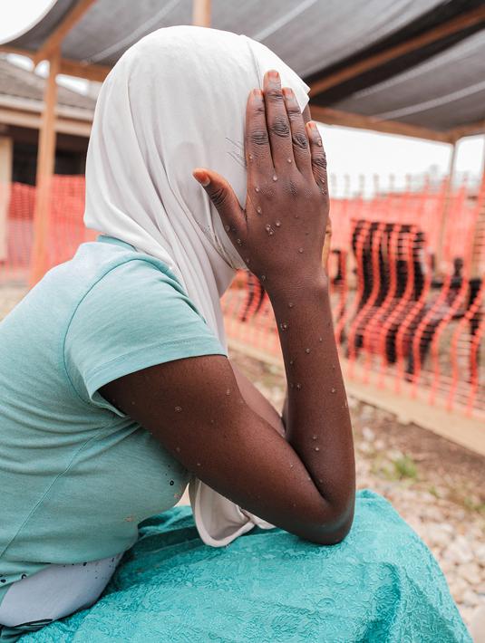 <p>&nbsp;</p>
<p>Clade 1b menyebabkan kematian pada sekitar 3,6 persen kasus, dengan anak-anak lebih berisiko, menurut WHO, yang telah mengumumkan keadaan darurat kesehatan internasional atas wabah terbaru ini. (Tchandrou NITANGA / AFP)</p>