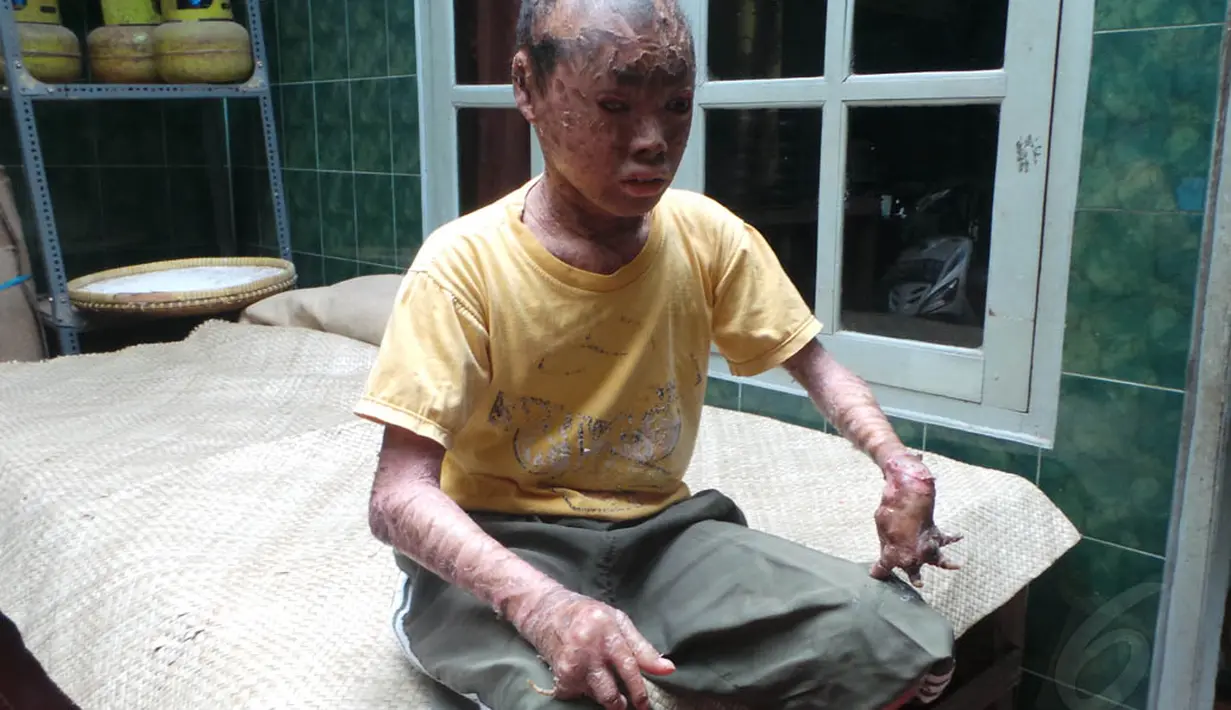 Ari Wibowo, remaja asal Tangerang ini memiliki penyakit sindrom manusia merah yang menyebabkan kulit di seluruh tubuhnya seperti bersisik dan kemudian mengelupas. (Liputan6.com/Benedikta Desideria)