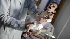Seorang bayi Suriah yang menderita kekurangan gizi parah digendong oleh perawat di sebuah klinik pinggiran kota Damaskus, yang dikuasai oposisi, 21 Oktober 2017. Bayi bernama Sahar Dofdaa itu meninggal pada Minggu (23/10). (Amer ALMOHIBANY/AFP)