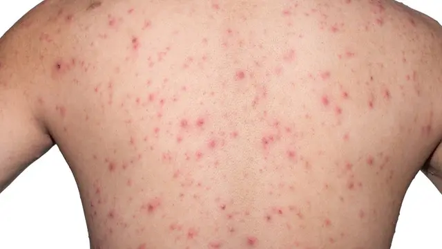 Scabies Adalah Infeksi Kulit, Kenali Tanda-Tanda dan Penyebabnya