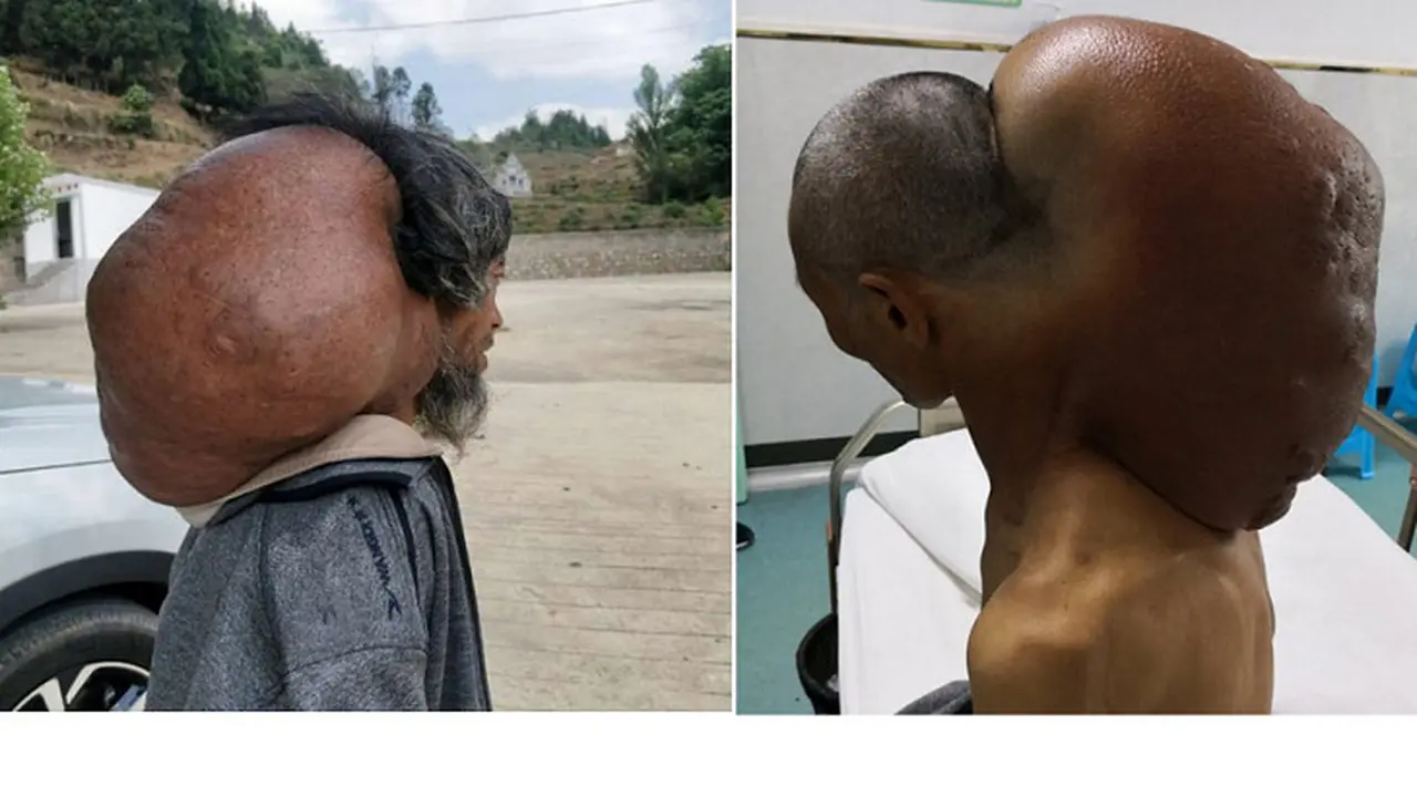 Dibiarkan Selama 47 Tahun, Pria Ini Punya Tumor Di Leher Seberat 15 Kg