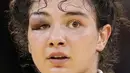 Madina Taimazova dari Komite Olimpiade Rusia mengalami memar pada bagian mata saat melawan Chizuru Arai dari Jepang dalam babak semifinal judo 70kg putri Olimpiade Tokyo 2020, Rabu (28/7/2021). (Foto: AP/Vincent Thian)