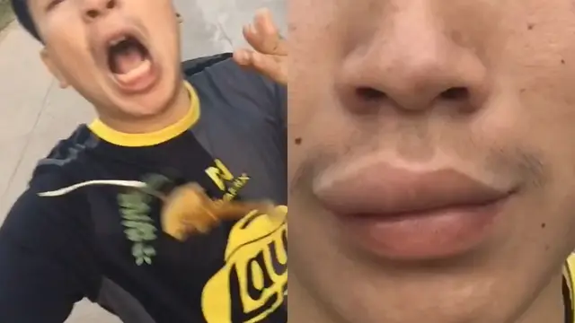 Bibir pemuda ini bengkak karena disengat lebah