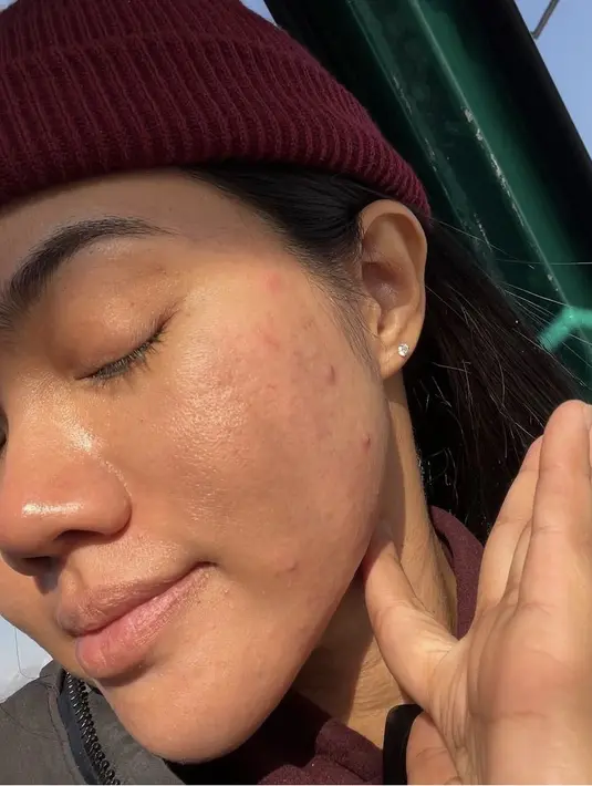 Yura pun tampil bareface dengan percaya diri menunjukan jerawatnya. Bahkan ia pun tampil tanpa lipstik. Credit: Instagram (@yurayunita)