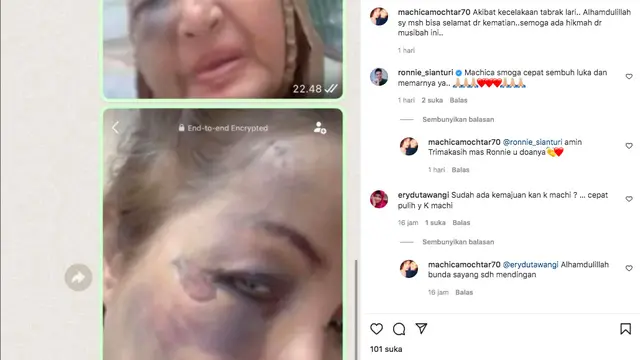 Penyanyi Senior Machica Mochtar Jadi Korban Tabrak Lari, Muka Penuh Lebam. (instagram.com/machicamochtar70)