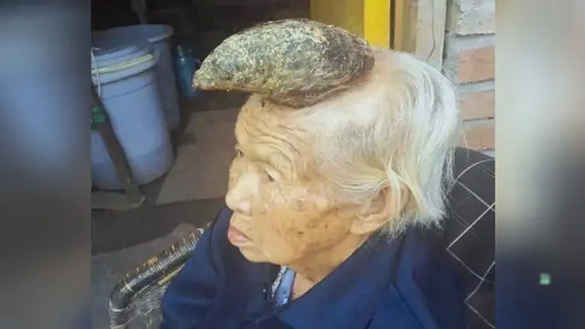 Seorang Nenek di China Ditumbuhi Tanduk 13 Sentimeter