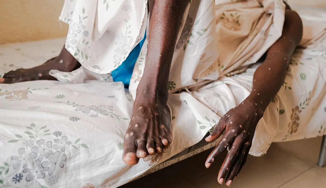 Seorang pria yang terinfeksi Mpox terbaring di tempat tidur di dalam bangsal pusat perawatan Mpox Rumah Sakit Universitas Kamenge di Bujumbura, ibu kota Burundi pada 22 Agustus 2024. (Tchandrou NITANGA / AFP)