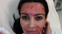 Kim Kardashian coba vampire facial. (dok. Instagram @kimkardashian)
