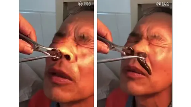 Sering Mimisan, Ternyata Ada Lintah Hidup di Hidung Pria Ini
