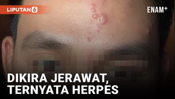 VIDEO: Dikira Jerawat, Pria Ini Ternyata Terinfeksi Herpes