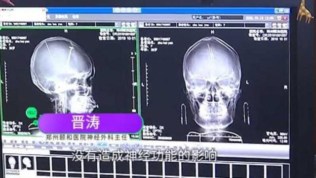 Tak Pernah Mengeluh Sakit Kepala, Wanita Ini Kaget Ada Jarum Tertanam di Otaknya