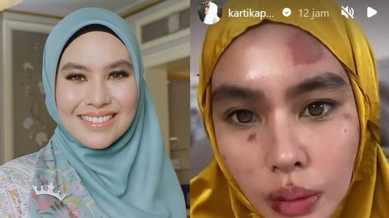 Kartika Putri alami wajah ruam (Instagram/kartikaputriworld)
