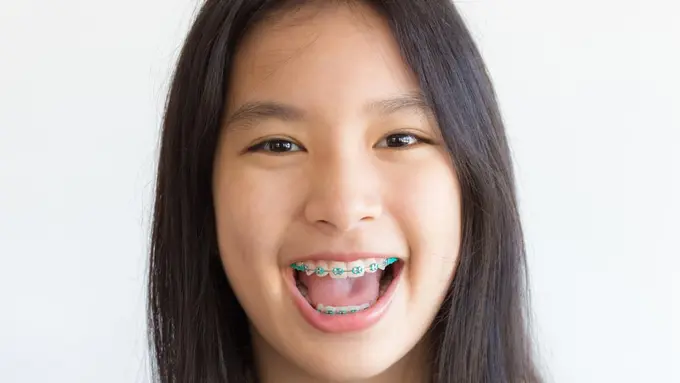 Kini merapihkan gigi tak perlu menggunakan behel (Toey Toey/Shutterstock)