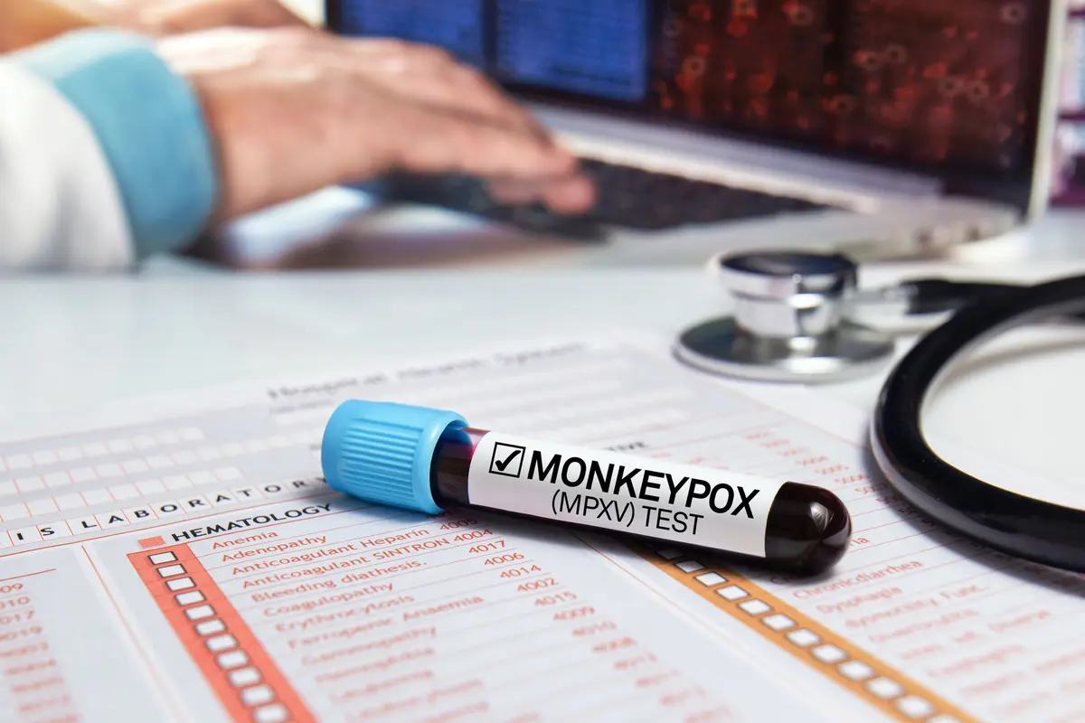 Ramai Monkeypox atau Mpox, Seperti Apa Penyebab, Gejala dan Cara Penanganannya?