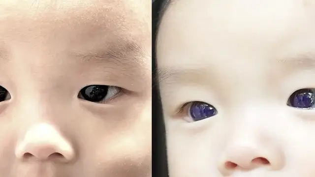 Warna mata seorang anak berusia 6 bulan tampak berubah