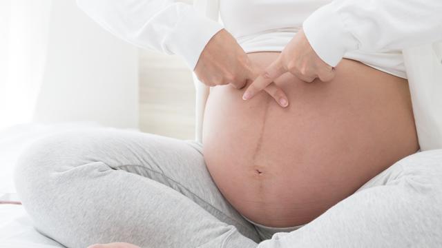 5 Hal Penting Tentang Linea Nigra Garis Memanjang Pada Perut Ibu Hamil Parenting Fimela Com