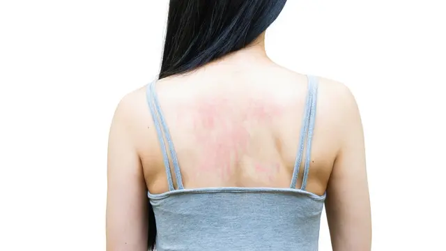 Fungal Acne.
