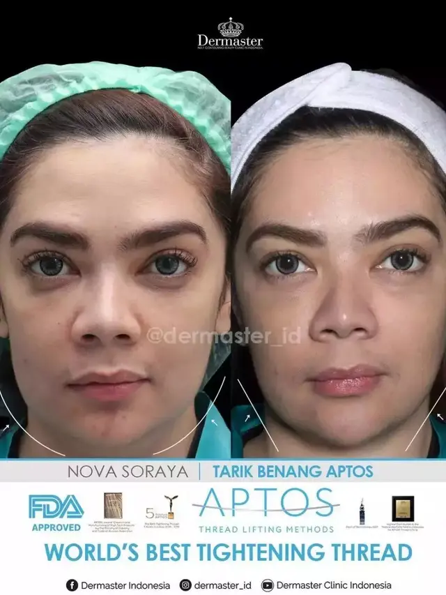 Potret Nova Soraya sebelum dan sesudah tanam benang (Sumber: Instagram/dermaster_id)