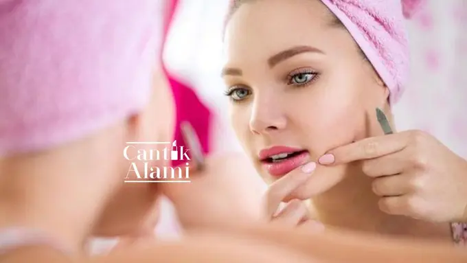 Cantik Alami: Jangan Dipencet, Pakai Racikan Ini Agar Jerawat Kempes