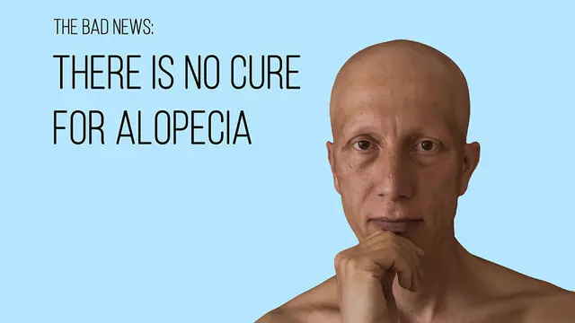 Idap Alopecia Universalis, Pria Ini Tunjukkan Kisahnya Melalui Potret Unik