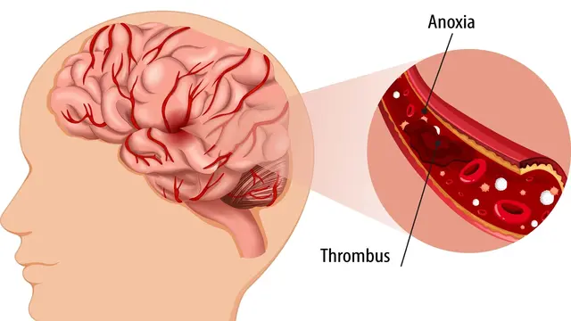 Ilustrasi Stroke Iskemik