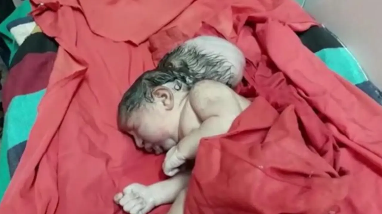 Kondisi Langka, Bayi Lahir dengan Tiga Kepala Bikin Geger