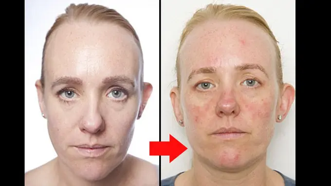 Anna Pursglove, foto sebelum dan sesudah (c) dailymail.co.uk