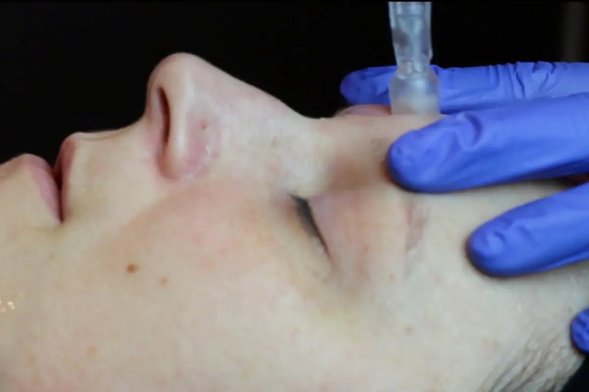 Dermastamp