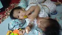 Dua bayi kembar siam asal Kendari, Aqila Dewi Sabila dan Azila Dewi Sabrina.(Liputan6.com/Ahmad Akbar Fua)