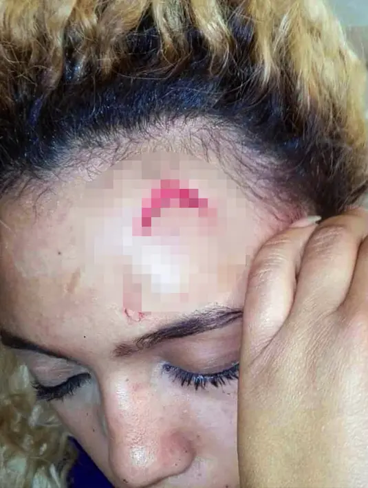 Gabriella Engels memperlihatkan luka di dahinya di Johannesburg, Afrika Selatan (14/8). Istri Presiden Robert Mugabe, Grace Mugabe menyerang model 20 tahun ini dengan menggunakan kabel. (Debbie Engels via AP)