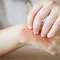 How to Relieve Itchy Skin After Contact with Caterpillar Hairs Without Expensive Medicine