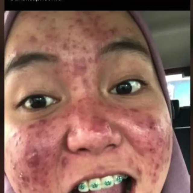 Gadis Jerawatan Kulitnya Berubah Jadi Mulus dan Bersinar sampai Mantannya Takjub