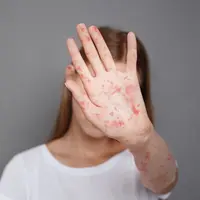 Ilustrasi campak pada dewasa. Dok. depositphotos.com