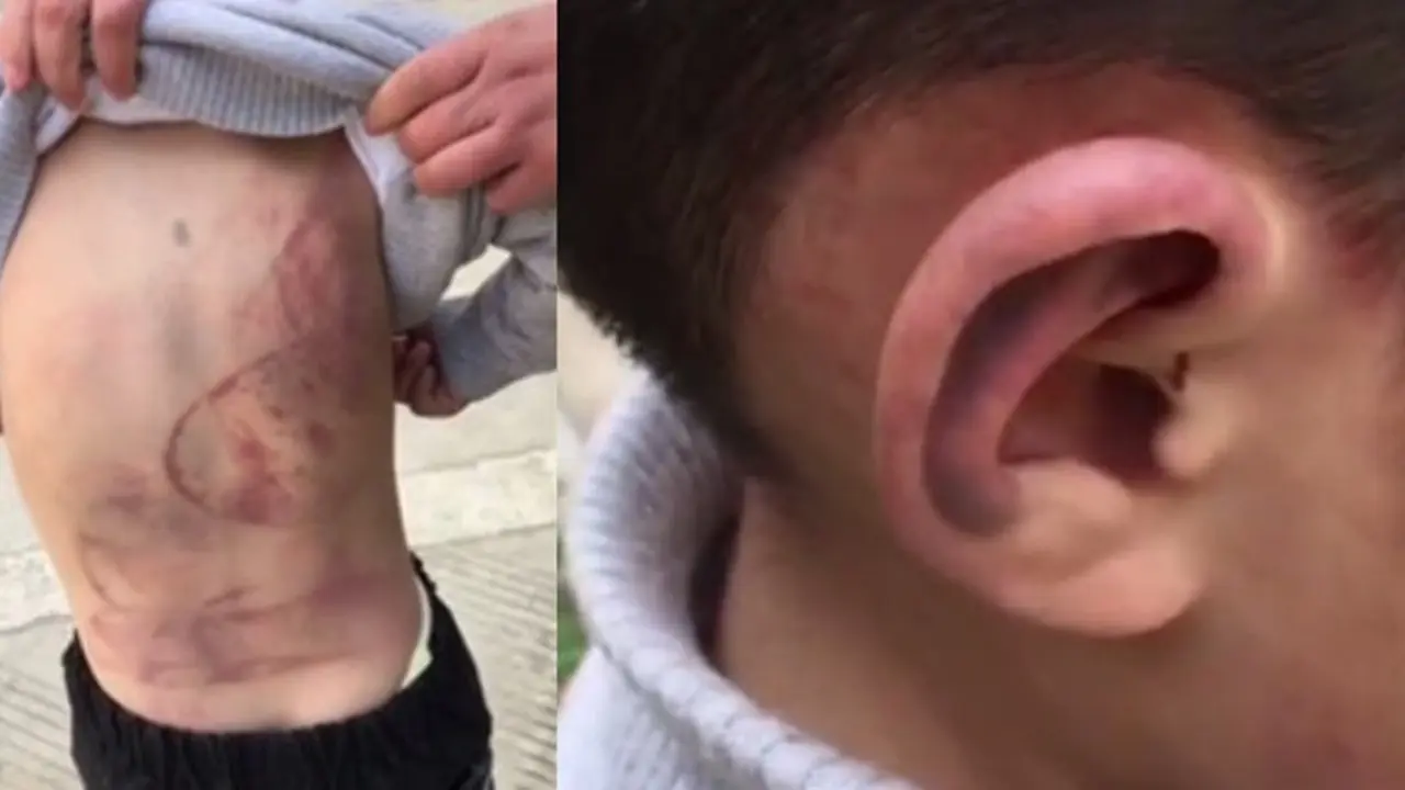 Dipukuli Ayah, Bocah 6 Tahun Babak Belur dan Tidur di Bawah Mobil