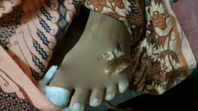 Luka kecil gigitan ular King kobra di telapak kaki kiri menyebabkan Fatimah, warga Banyumas, meninggal dunia. (Foto: Liputan6.com/BPBD BMS/Muhamad Ridlo)