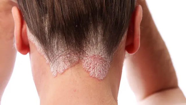 Di kulit kepala, di bawah rambut