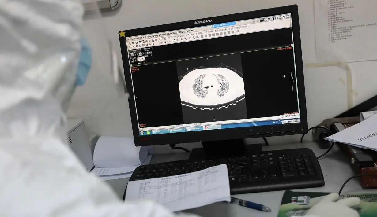 Dokter melihat gambar CT di bangsal isolasi Rumah Sakit Palang Merah di Wuhan, 16 Februari 2020. Virus Corona yang bermula di China tengah pada Desember 2019 kini menyebar secara global di mana lima negara terdampak paling besar, yakni Cina daratan, Korea Selatan, Iran, Italia dan Jepang (STR/AFP)