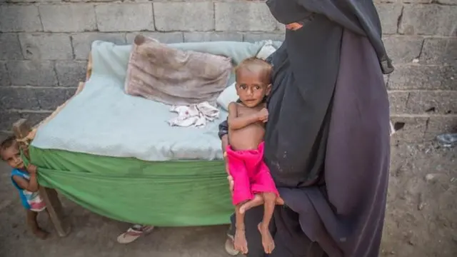 Balita di Yaman yang mengalami gizi buruk (supplied / Save the Children UK)