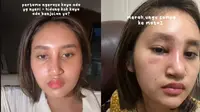 6 Potret Kronologi Dhyaz Anak Farida Nurhan Alami Infeksi Hidung Pasca Implan