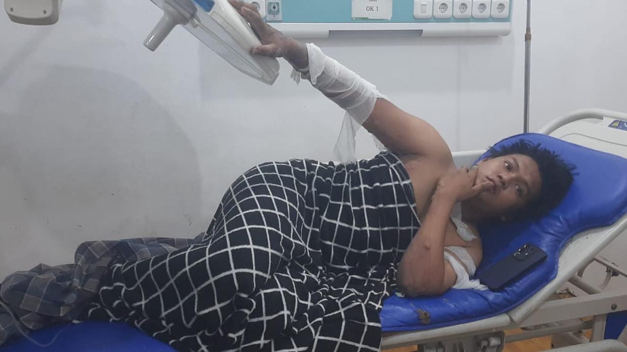 Korban luka bakar di Makassar