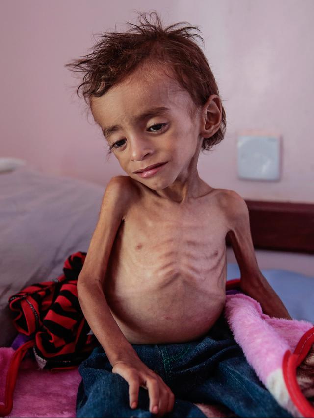 Begini Kondisi Anak-Anak Yaman Penderita Gizi Buruk