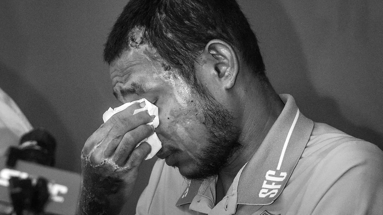 Foto: Muncul ke Publik untuk Pertama Kalinya, Begini Kondisi Pemain Malaysia Faisal Halim setelah Penyiraman Air Keras