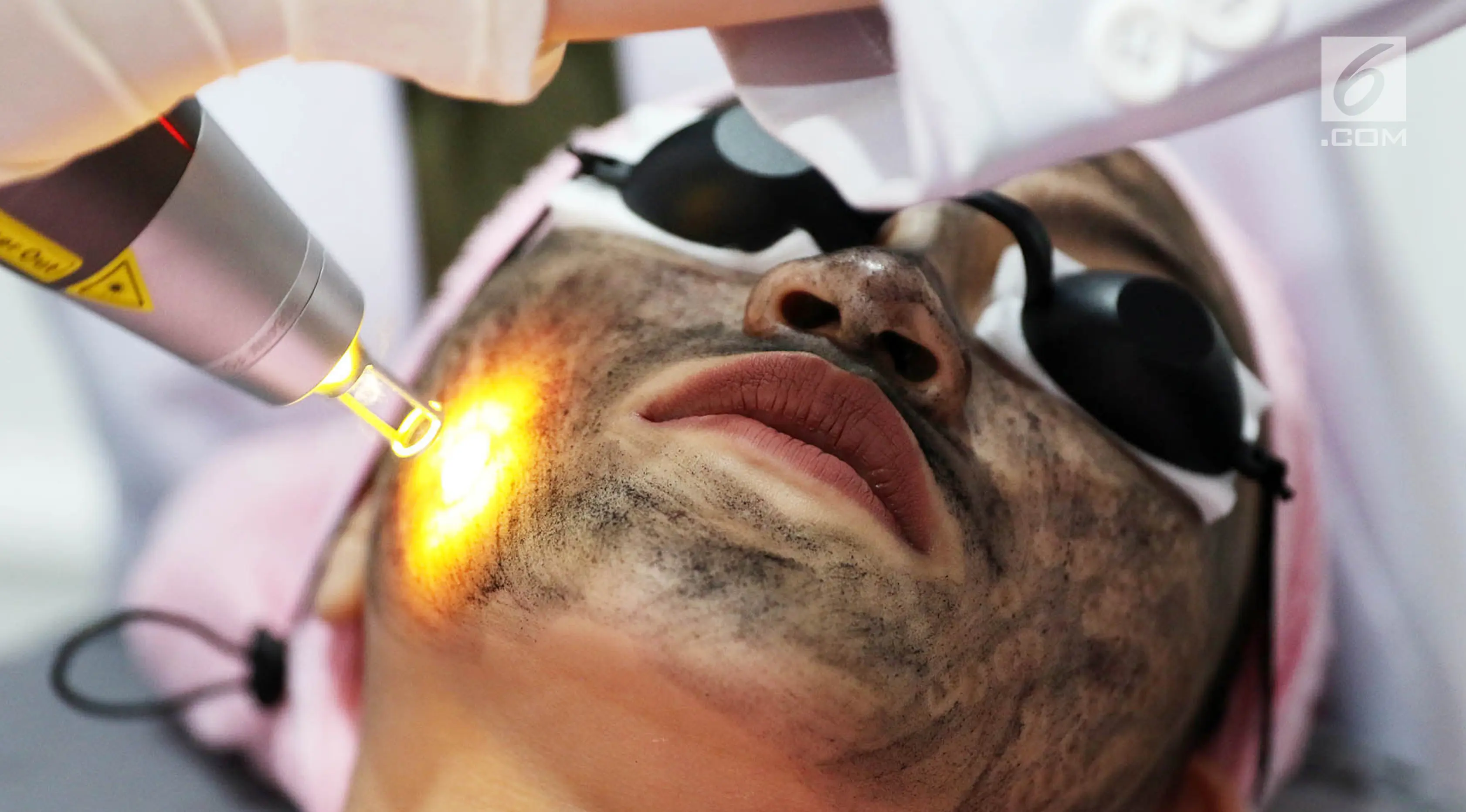 Beautylogica clinic Sudirman, laser Nd-YAG treatment (Liputan6.com/Immanuel Antonius)