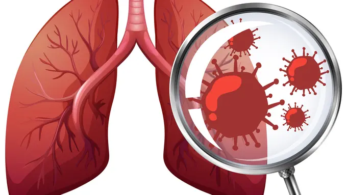Kenali gejala kanker paru yang sering terabaikan