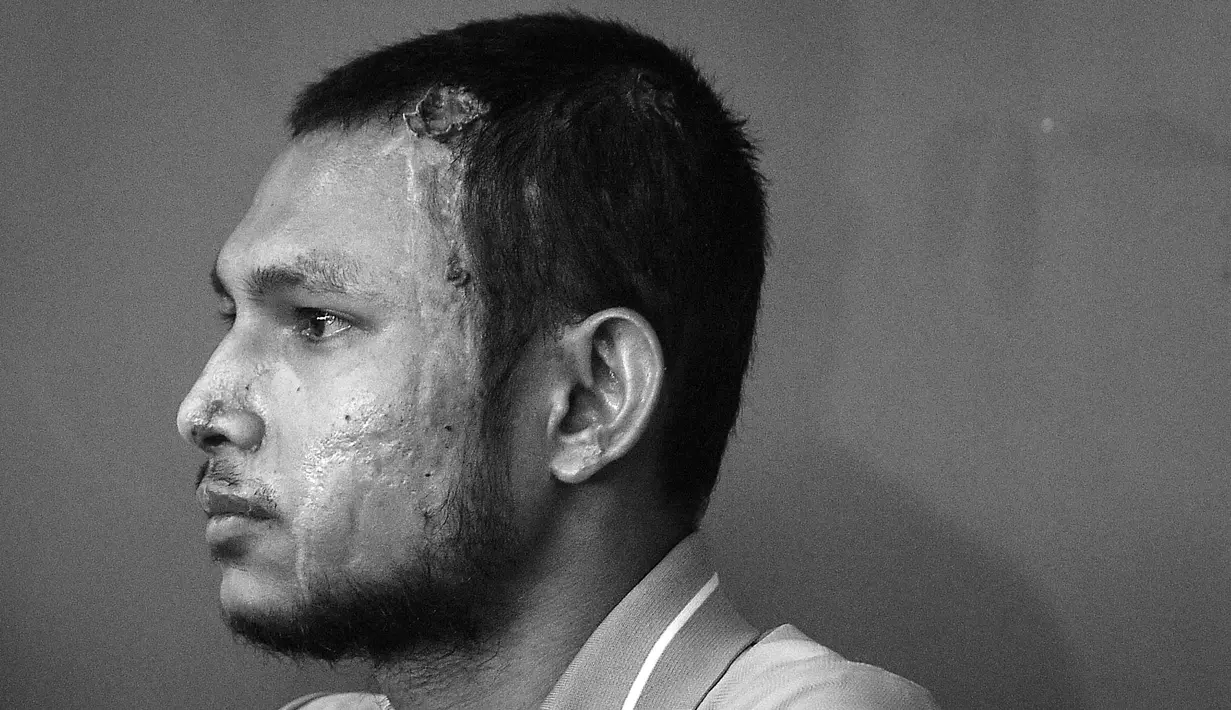 Pemain Malaysia, Faisal Halim saat jumpa pers pemusatan latihan Selangor FC di Padang SUK Shah Alam, Kamis (13/6/2024). Terlihat luka bakar di sejumlah bagian tubuhnya akibat insiden penyiraman air keras oleh orang yang tak dikenal pada 5 Mei 2024. (AFP/Arif Kartono)