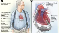 Dengan teknologi Continous Left Ventricular Assist Device (CF-LAVD), harapan hidup pasien gagal jantung lebih panjang makin terbuka lebar.
