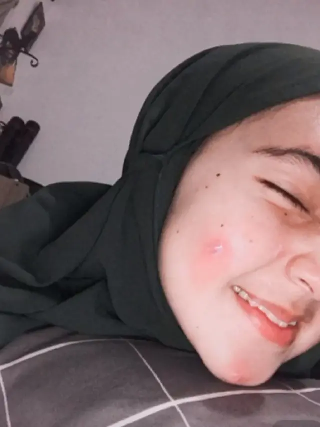 jerawat
