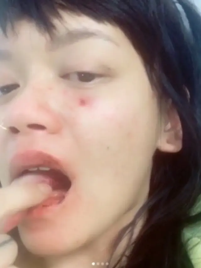 Lidah Dylan terpotong karena kekerasan yang ia alami ©instagram/dylan_sada